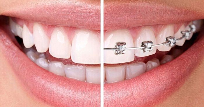 ارتودنسی ارتودنسی بهترین راه برای مرتب‌سازی دندان‌ها و اصلاح ناهنجاری‌های فکی است. با روش‌های ثابت، متحرک و نامرئی لبخندی زیبا داشته باشید.