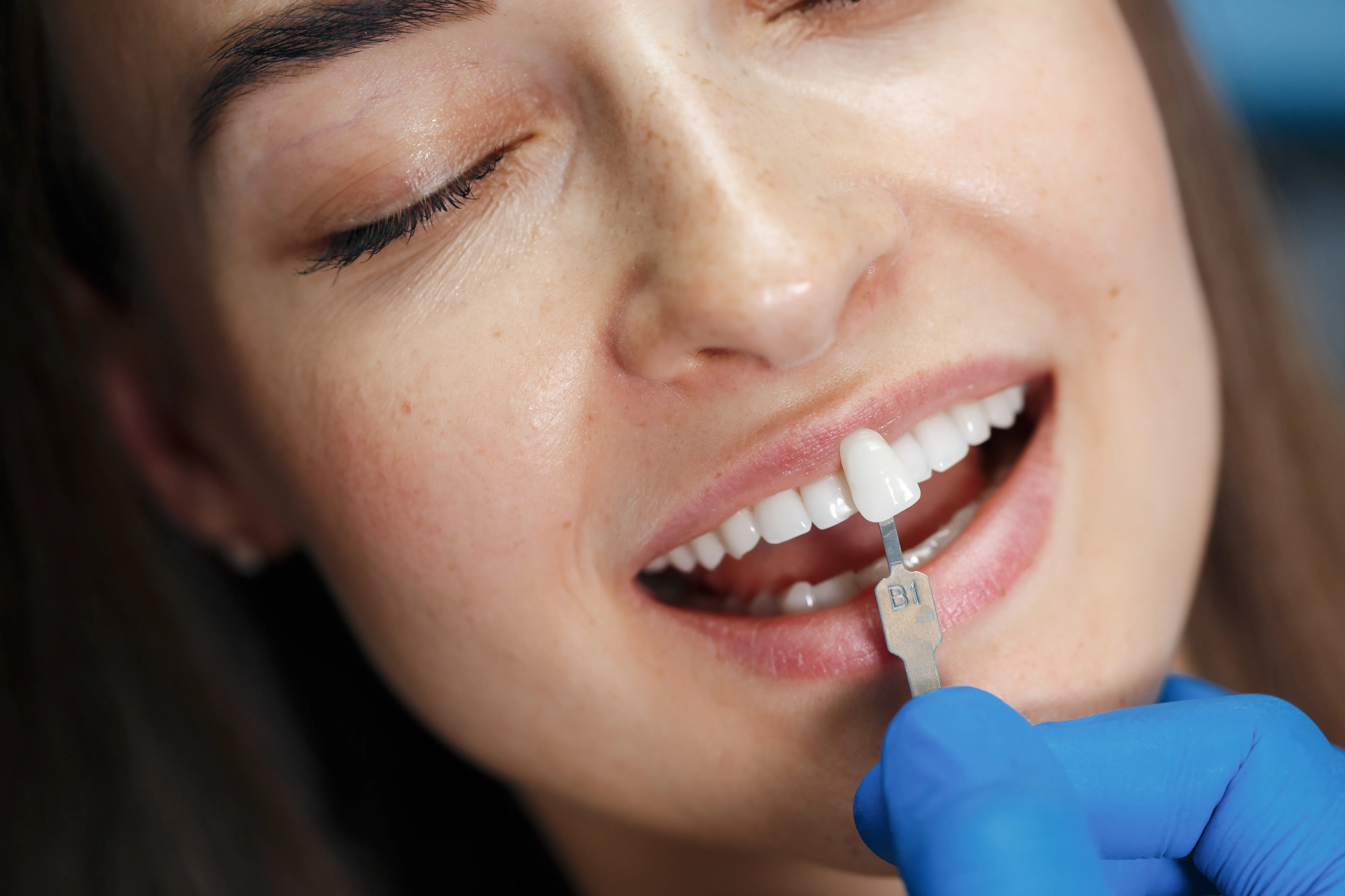 یکی از مهم‌ترین ویژگی‌های لمینت، طبیعی بودن نتیجه نهایی آن است. به دلیل شفافیت و انعکاس نور مشابه مینای طبیعی دندان، لمینت‌ها ظاهری بسیار طبیعی ایجاد می‌کنند.