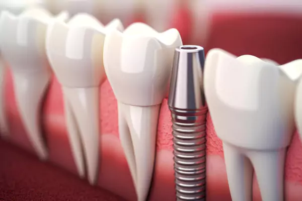 یکی از مهم‌ترین ویژگی‌های لمینت، طبیعی بودن نتیجه نهایی آن است. به دلیل شفافیت و انعکاس نور مشابه مینای طبیعی دندان، لمینت‌ها ظاهری بسیار طبیعی ایجاد می‌کنند. لمینت