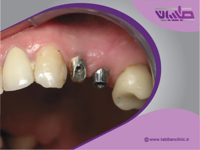 ایمپلنت پانچ چیست و چگونه انجام میشود؟